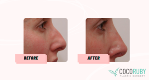 Will Medicare cover my Nose Surgery? 3 Coco Ruby Blog - Before and After Nose Surgery Sample Gallery Image