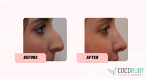 Will Medicare cover my Nose Surgery? 1 Coco Ruby Blog - Before and After Nose Surgery on Medicare Banner Image