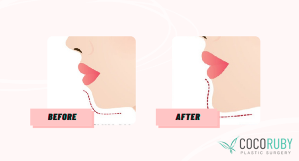 Coco Ruby Plastic Surgery Blog - claim my Chin Surgery on Medicare Before and After Image Illustration