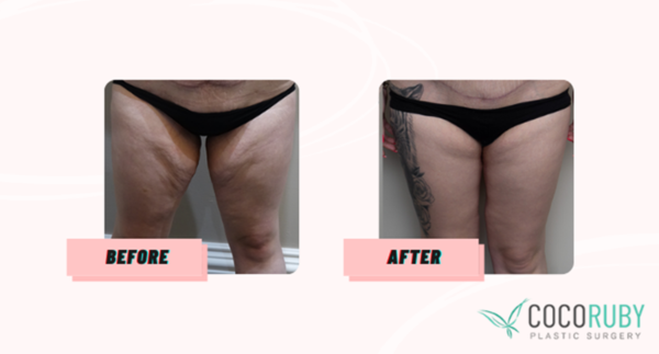 Coco Ruby Plastic Surgery- Medicare Cover my Thigh Lift Surgery Before and After Comparison Image