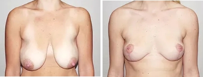 Melbourne Breast Lift (Mastopexy) - 2