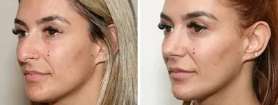Revision Rhinoplasty | Nose Surgery Revision Melbourne - 1